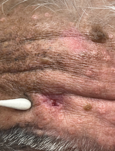 Skin Cancer Removal & Repair 2 Before Image