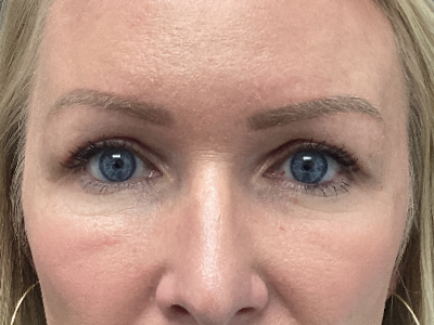 Upper Blepharoplasty 1 After Image