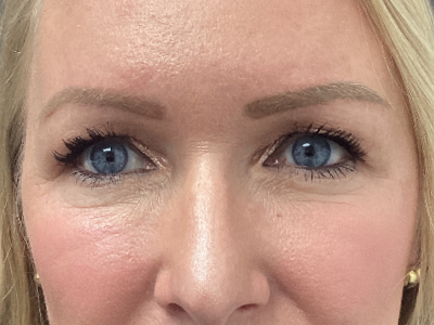 Upper Blepharoplasty 1 Before Image
