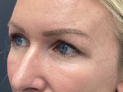 Upper Blepharoplasty 1 After Image