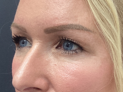 Upper Blepharoplasty 1 Before Image