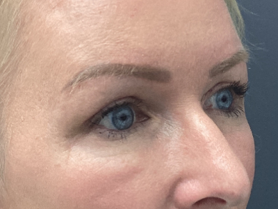 Upper Blepharoplasty 1 After Image