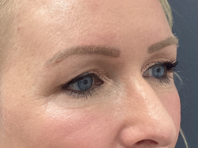 Upper Blepharoplasty 1 Before Image
