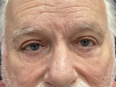 Upper + Lower Blepharoplasty 1 After Image