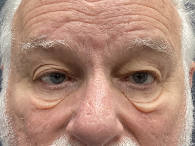 Upper + Lower Blepharoplasty 1 Before Image