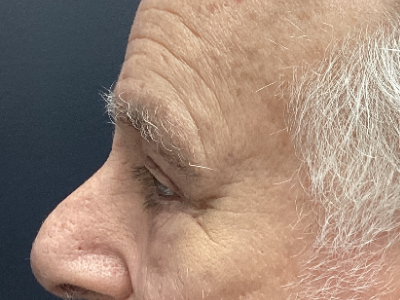 Upper + Lower Blepharoplasty 1 After Image