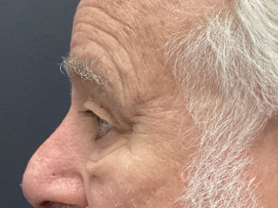 Upper + Lower Blepharoplasty 1 Before Image
