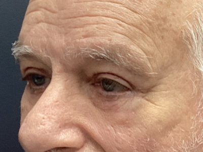 Upper + Lower Blepharoplasty 1 After Image