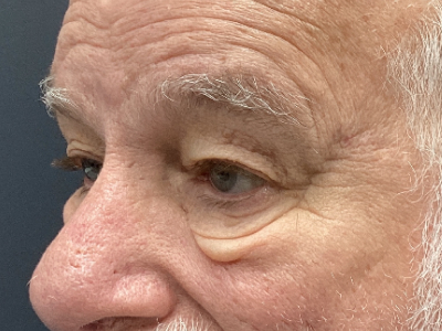 Upper + Lower Blepharoplasty 1 Before Image