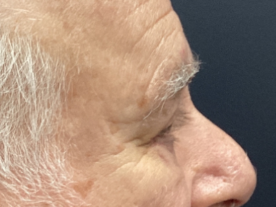 Upper + Lower Blepharoplasty 1 After Image