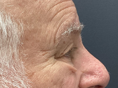 Upper + Lower Blepharoplasty 1 Before Image