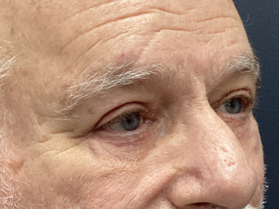 Upper + Lower Blepharoplasty 1 After Image