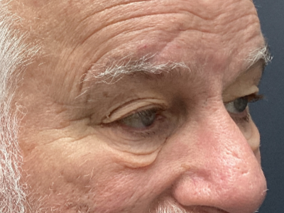 Upper + Lower Blepharoplasty 1 Before Image