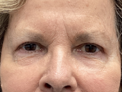 Upper + Lower Blepharoplasty 2 After Image