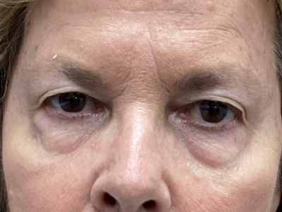 Upper + Lower Blepharoplasty 2 Before Image