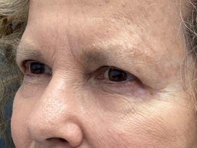 Upper + Lower Blepharoplasty 2 After Image