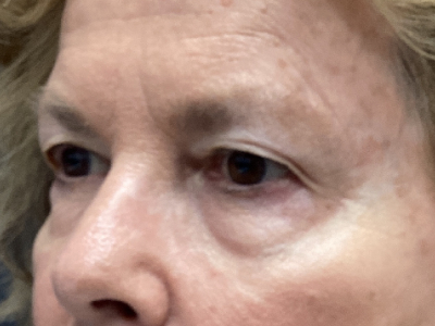 Upper + Lower Blepharoplasty 2 Before Image