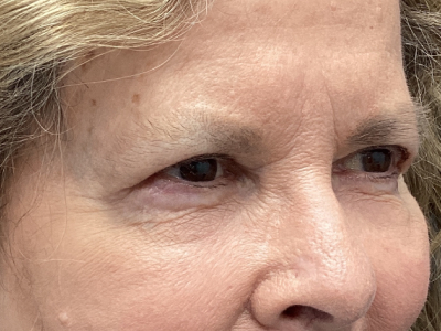 Upper + Lower Blepharoplasty 2 After Image