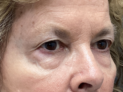 Upper + Lower Blepharoplasty 2 Before Image