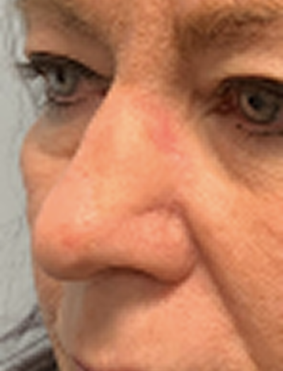 Nose Reconstruction 1 After Image