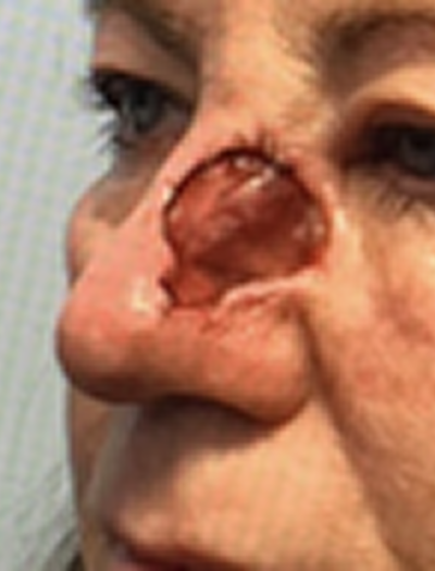 Nose Reconstruction 1 Before Image