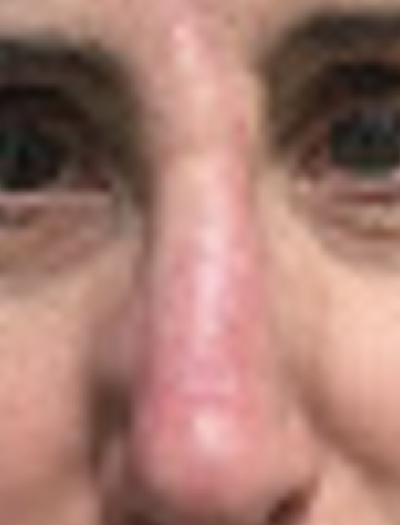 Nose Reconstruction 2 After Image