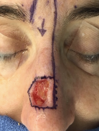 Nose Reconstruction 2 Before Image