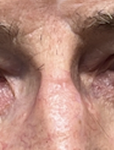 Nose Reconstruction 3 After Image