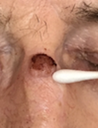 Nose Reconstruction 3 Before Image