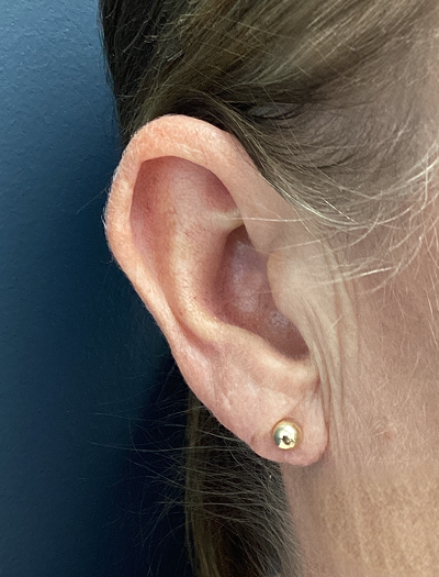 Earlobe Reduction 1 After Image
