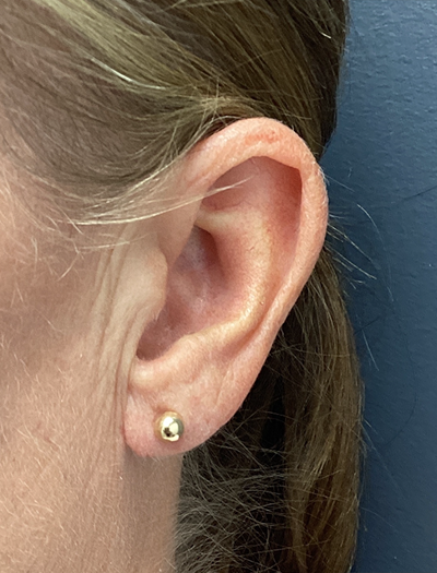 Earlobe Reduction 1 After Image