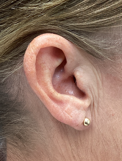 Earlobe Reduction 1 After Image