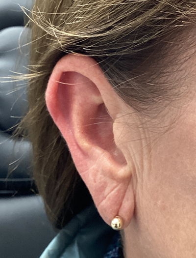 Earlobe Reduction 1 Before Image