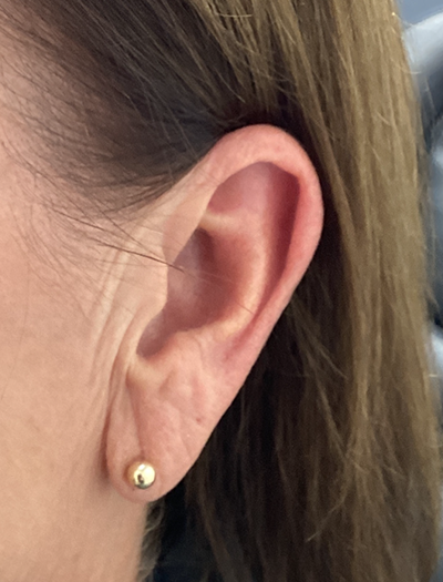 Earlobe Reduction 1 Before Image