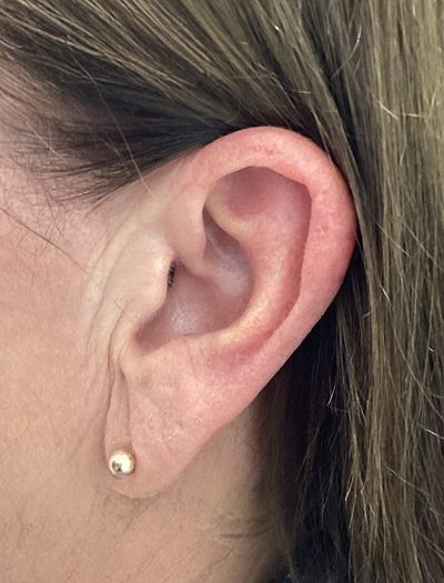 Earlobe Reduction 1 Before Image