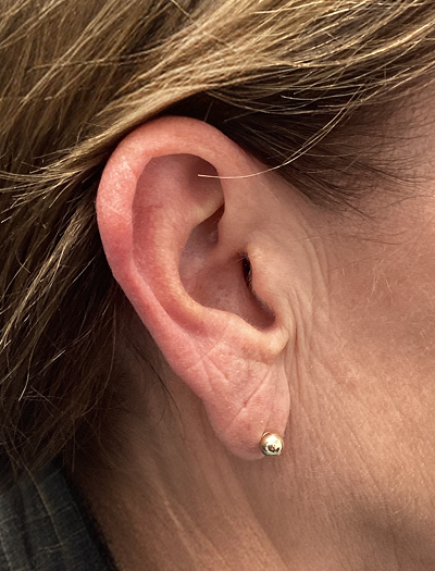 Earlobe Reduction 1 Before Image