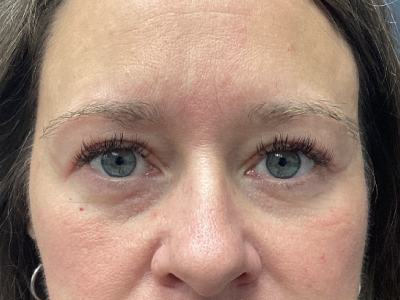 Brow Lift & Upper Blepharoplasty After Image