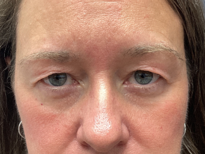 Brow Lift & Upper Blepharoplasty Before Image