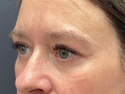 Brow Lift & Upper Blepharoplasty After Image