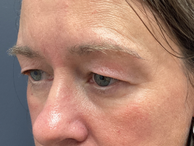 Brow Lift & Upper Blepharoplasty Before Image
