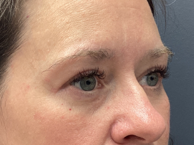 Brow Lift & Upper Blepharoplasty After Image