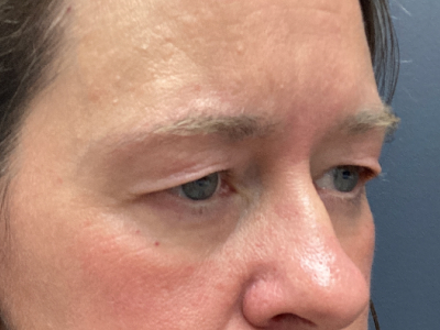 Brow Lift & Upper Blepharoplasty Before Image