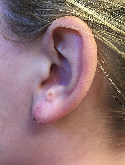 Keloid Removal & Repair 1 After Image