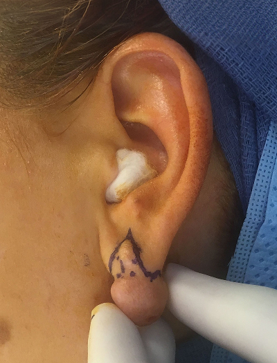 Keloid Removal & Repair 1 Before Image