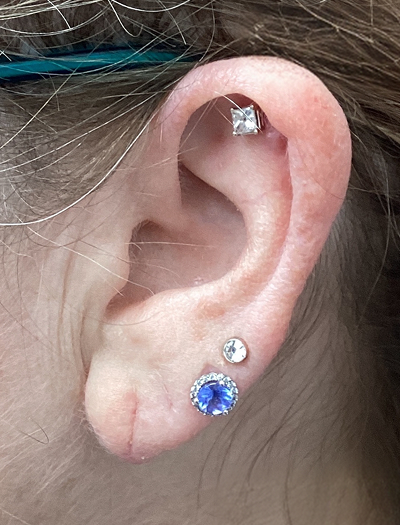 Earlobe Repair 1 After Image