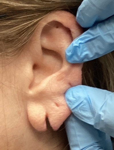 Earlobe Repair 1 Before Image