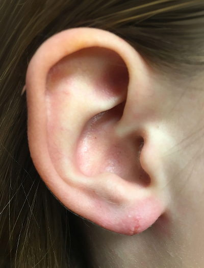 Earlobe Repair 2 After Image