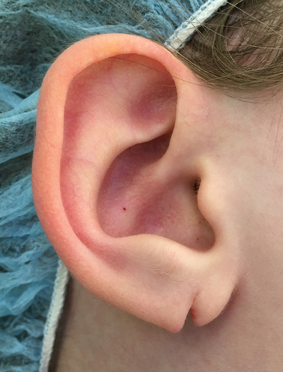 Earlobe Repair 2 Before Image