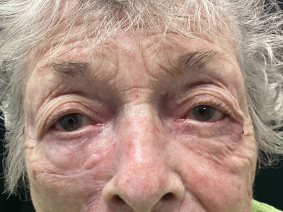 Ectropion Repair 1 After Image