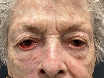 Ectropion Repair 1 Before Image